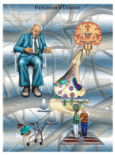 酷牌库|商品详情-3B Scientific进口代理批发 解剖图：帕金森病