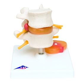 Anatomical Model 12-4576 3B Scientific Anatomical Model - Lumbar Spinal Column With Prolapsed Intervertebral Disc - Includes 3B Smart Anatomy