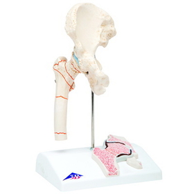 Anatomical Model 12-4577 3B Scientific Anatomical Model - Femoral Fracture And Hip Osteoarthritis - Includes 3B Smart Anatomy
