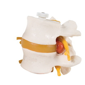Anatomical Model 12-4595 3B Scientific Anatomical Model - 2 Lumbar Vertebrae With Prolapsed Disc, Flexibly Mounted - Includes 3B Smart Anatomy
