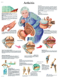 3B Scientific 12-4605L Anatomical Chart - Arthritis, Laminated