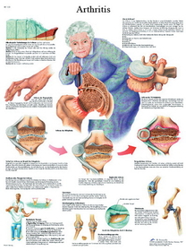 3B Scientific 12-4605P Anatomical Chart - Arthritis, Paper