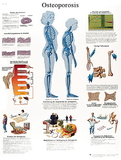 3B Scientific 12-4615L Anatomical Chart - Osteoporosis, Laminated