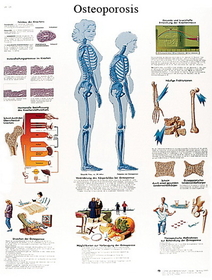 3B Scientific 12-4615P Anatomical Chart - Osteoporosis, Paper