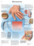 3B Scientific 12-4618L Anatomical Chart - Rheumatic Diseases, Laminated