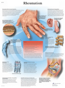 3B Scientific 12-4618P Anatomical Chart - Rheumatic Diseases, Paper